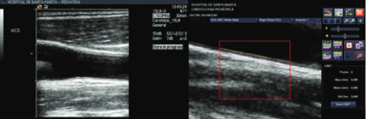 Figura  7.  Ultrassonografia  da  carótida  comum  (casuística  do  estudo):  identificação  da  região  alvo  pretendida  (imagem da esquerda) e gravação das imagens