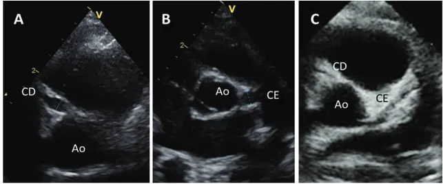 Figura 1. Aspectos ecocardiográficos das artérias coronárias na DK (casuística institucional): (A e B) aneurismas  na porção inicial da coronária direita (CD) com 6 mm (Z score +5) e do tronco comum da coronária esquerda (CE)  com 7,2 mm (Z score de +6); (