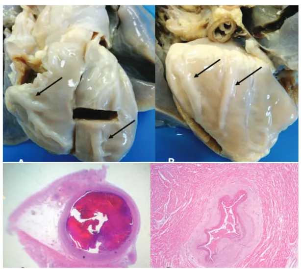 Figura 3. Imagens de peça anatómica de autópsia de coração, de um lactente falecido por enfarte do miocárdio  devido a DK (casuística institucional)