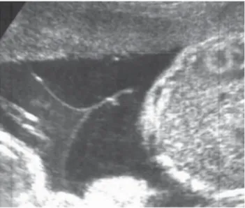 Figura  1-Gravidez  gemelar  monocoriónica  às  16  semanas  de  gestação  afectada  por  síndrome  de  transfusão feto-fetal precoce que apresenta dobramento da membrana interfetal
