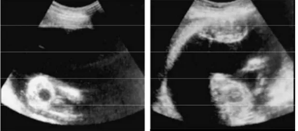 Figura  2-  Síndrome  de  transfusão  feto-fetal  severo  às  20  semanas  de  gestação