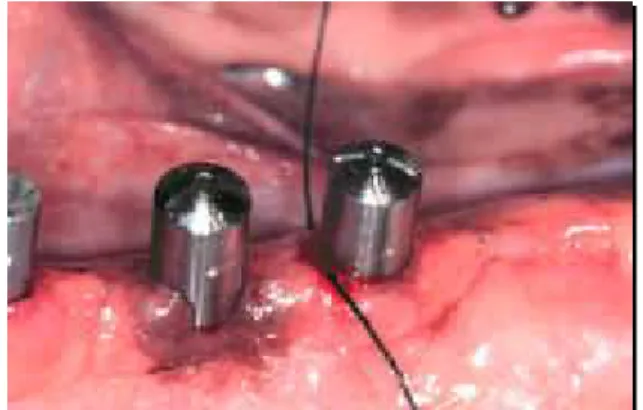 FIGURA 15 - Aspecto da mucosa peri-            FIGURA 16 - Sutura lingual para         Implantar no tempo 0                                        prender   a ligadura 
