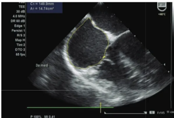 Figure 3: Determination of visible LA area and dimension (distance from the first echo from LA to aortic valve) in the aortic plane.
