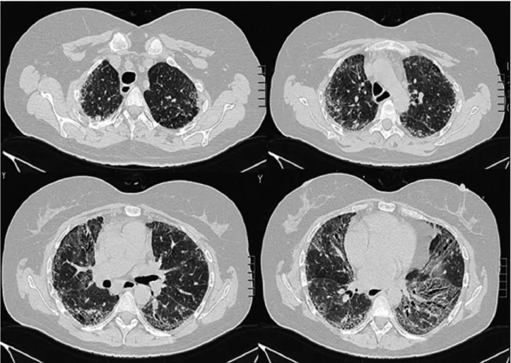 Figura 2 - Tomografia computadorizada de tórax (junho de 2014), em cortes transversais, que revela extensas áreas em vidro despolido,  sobretudo nos lobos inferiores, em relação com fibrose já estabelecida, e imagens quísticas periféricas subpleurais