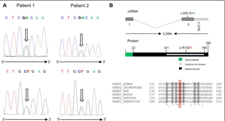 Fig. 1 a Forward and reverse DNA sequence chromatograms of patient 1 and 2 showing the c.455G &gt; A allelic variant (highlighted by arrows).