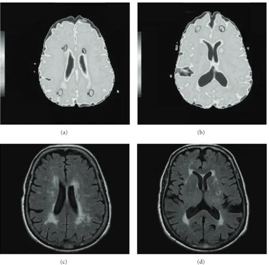 Figure 1: (a) and (b) ADC Map with representation of Regions of interest in Parieto-Occipital Normal Appearing White Matter (NAWM) and lesioned white matter (LWM) (a) and Frontal Normal Appearing White Matter (NAWM) (b)