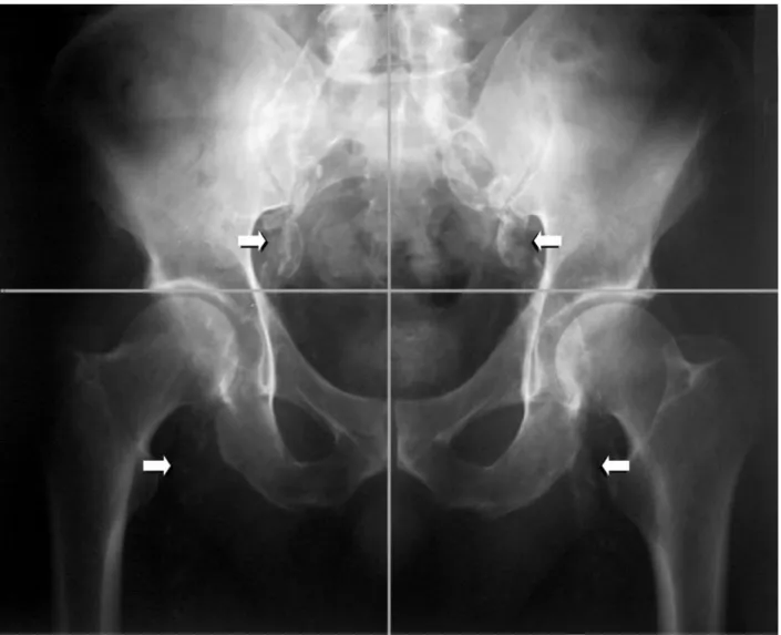 Fig. 1. Calciﬁcation score is the sum of the presence (1) or absence (0) of parallel linear calciﬁcations in each section