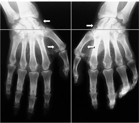 Fig. 2. Hands score in this example is 4; total score is the sum of pelvis and hands score [8].