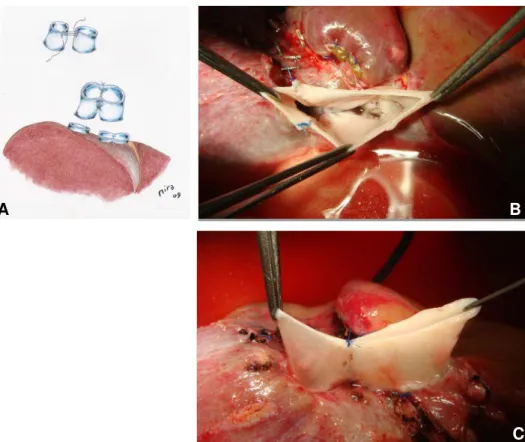 Figura 12. A) B) e  C) Cavo-cavoplastia em calção. Imagens e representação  gráfica.   