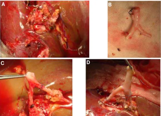 Figura 13. A) B) C)  e  D)  Reconstrução com anastomose de artéria hepática  esquerda substituída  vinda da artéria gástrica esquerda, à artéria  gastro-duodenal (pontos separados de polipropileno 7/0 sob ampliação 2,8x)