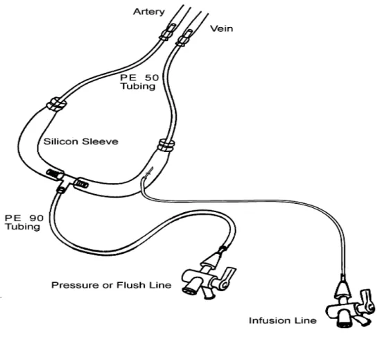 Figure 6 - Extracorporal arterial-venous circuit. Inserted to permit external blood circulation from the  femoral  artery  to  the  internal  jugular  vein