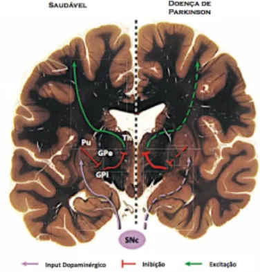Figura 1- Anatomia E Fisiologia Da DP. Esquema simplificado dos circuitos neuronais envolvendo o  núcleo da base, o tálamo (Th) e o córtex e as alterações sofridas por estas estruturas na DP