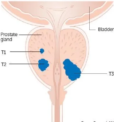 Figura 5: Possível localização   de tumores na próstata.  