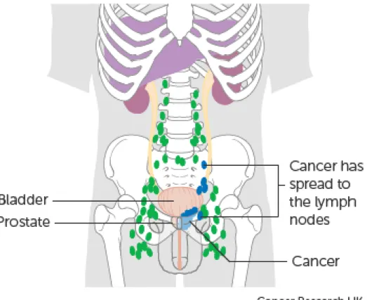 Figura 6: Possível localização de tumores nos nódulos linfáticos. Fonte: UK cancer research
