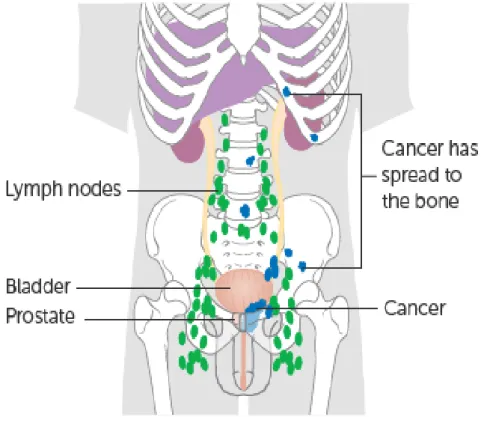 Figura  7:  Mostra  as  possíveis  localizações  de  tumores  metastizados.  Fonte:  UK  cancer  research