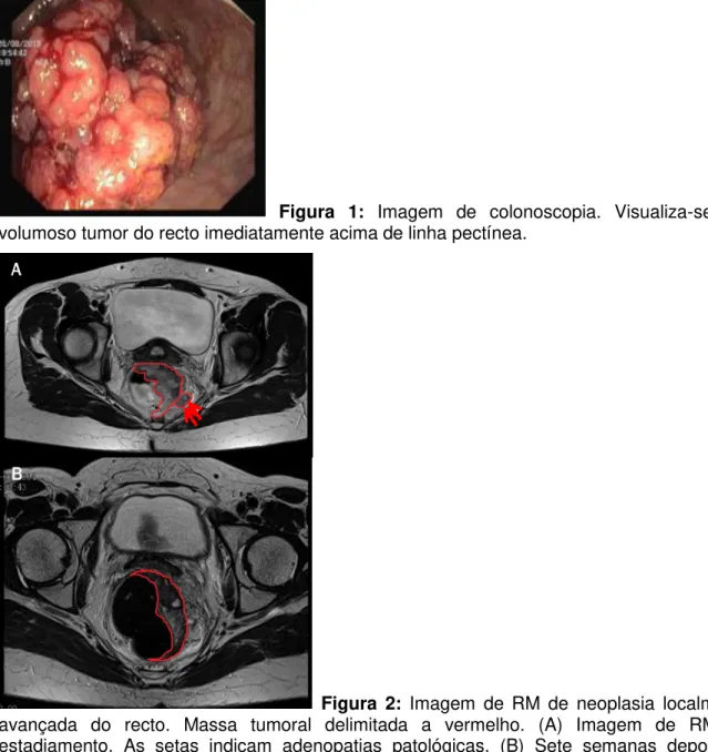 Figura  1:  Imagem  de  colonoscopia.  Visualiza-se  um  volumoso tumor do recto imediatamente acima de linha pectínea