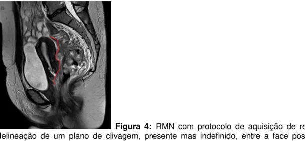 Figura  5:  (A)  RMN  pélvica  com  delimitação  da  peça  cirúrgica  ressecada.  (B)  A  referida  peça  de  recto,  útero,  anexos  e  porção superior da vagina que foi retirada em bloco para não se atingir o tumor