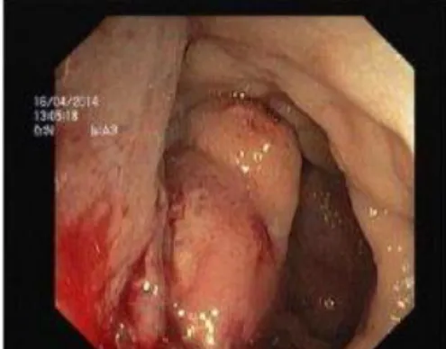 Fig.  1  Lesão  do  recto  observada  por  colonoscopia. 