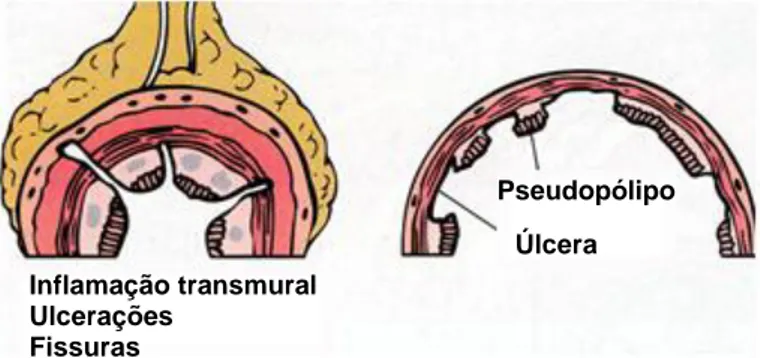 Figura  3.  Ilustração  de  alguns  dos  achados  histológicos  típicos  da doença de Crohn (adaptado de 15)