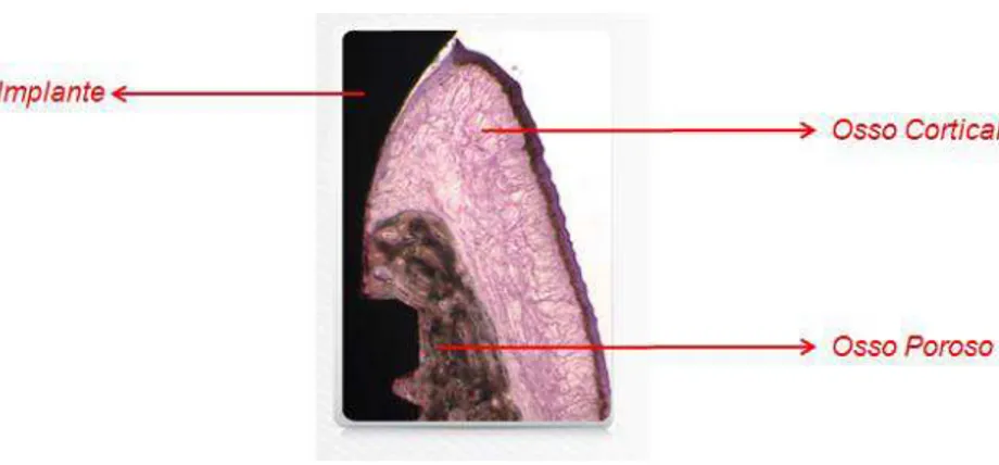 Figura 3 – Implante  real instalado  com detalhe  para a divisão  dos ossos mandibulares