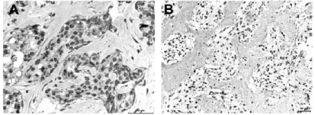 Figure 1. A. Simple mammary carcinoma of a female dog. Snai-1 nuclear expression in  luminal cells, cells of the invasive front and stromal cells B