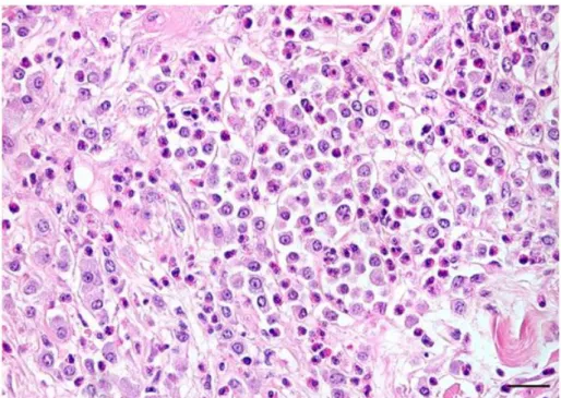 Fig. 4.7. Mastocitoma de grau II. Observam-se imagens de degradação do colagénio e eosinofilia  moderada