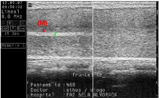 Figura 6- Imagem ultra-sonográfica do testículo esquerdo de um bovino de 18 meses no plano frontal