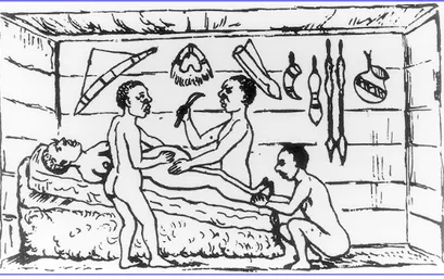 Fig. 32-  R.W. FELKIN (1879) «Cesariana praticada por curandeiros de Kamura, Uganda» 