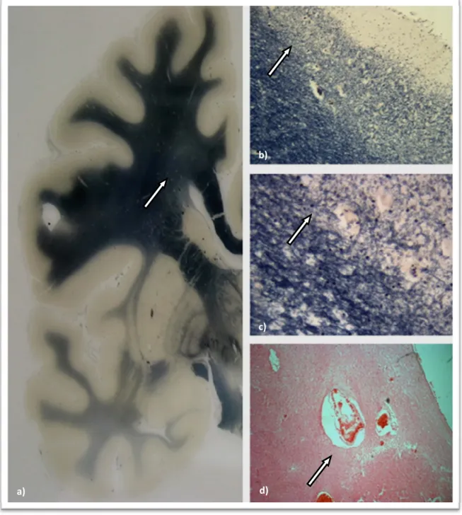 Figura  3  ‐  Patologia  das  ASBRE.  a)  Corte  coronal  do  hemisfério  cerebral  esquerdo.  A  seta  indica  a  substância  branca  lesada  (Woelke  ‐  coloração  para  a mielina);  b) Maior  ampliação  da  zona  lesada  (seta),  evidenciando  a  transi