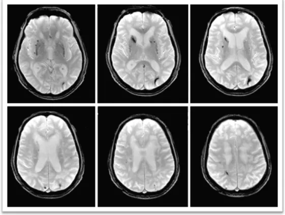 Figura  4 –  Micro‐hemorragias  –  Sequência  RM  ponderada  em T2  eco  de  gradiente (T2*), mostrando pequenos  depósitos de hemossiderina, correspondendo a micro‐hemorragias, num doente com ASBRE. Da esquerda para a  direita,  cortes  axiais  passando  