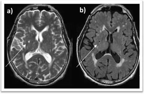 Figura  6  ‐  Enfarte  lacunar  em  RM  ‐  a)  Corte  axial,  sequência  ponderada  em  T2  FSE;  b)  Corte  axial,  sequência  ponderada em T2 Fast FLAIR.          Figura 7 ‐ Espaços perivasculares de Virchow‐Robin dilatados ‐ a) Corte axial, sequência po