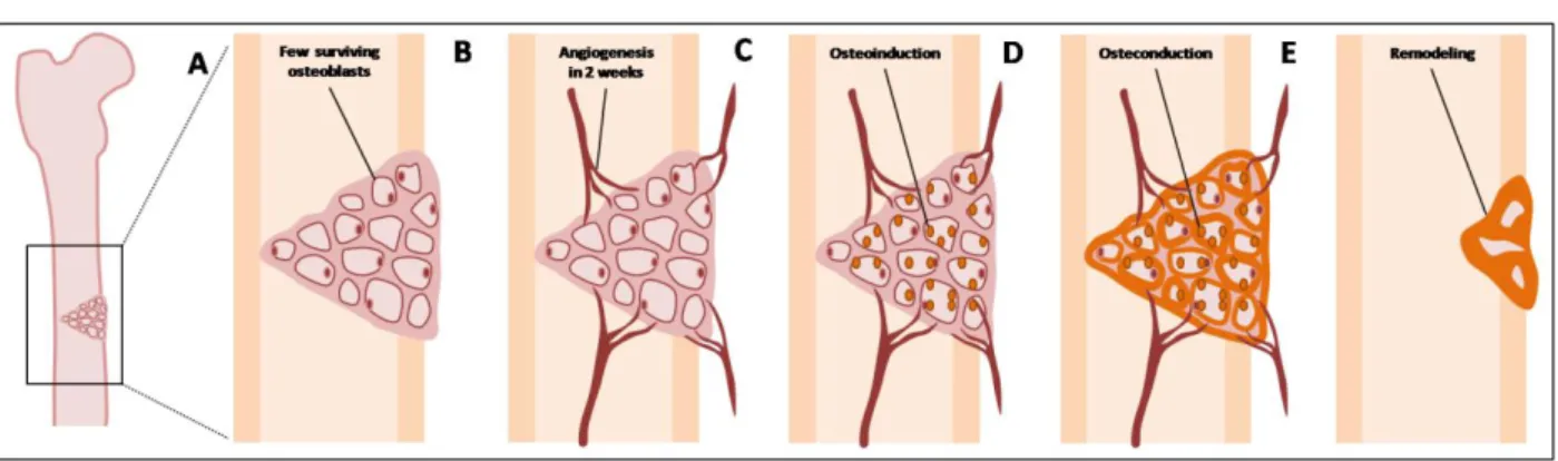 Figure 2 – Bone grafting procedure in a bone defect. A – Graft application – Hematoma formation with the release  of cytokines and growth factors