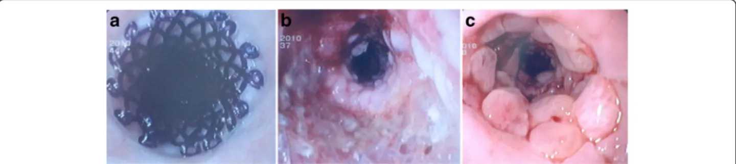 Figure 1 (a) Endoscopic view of a biodegradable stent immediately after placement. (b) Endoscopic appearance of the process of biodegradation at 2 months