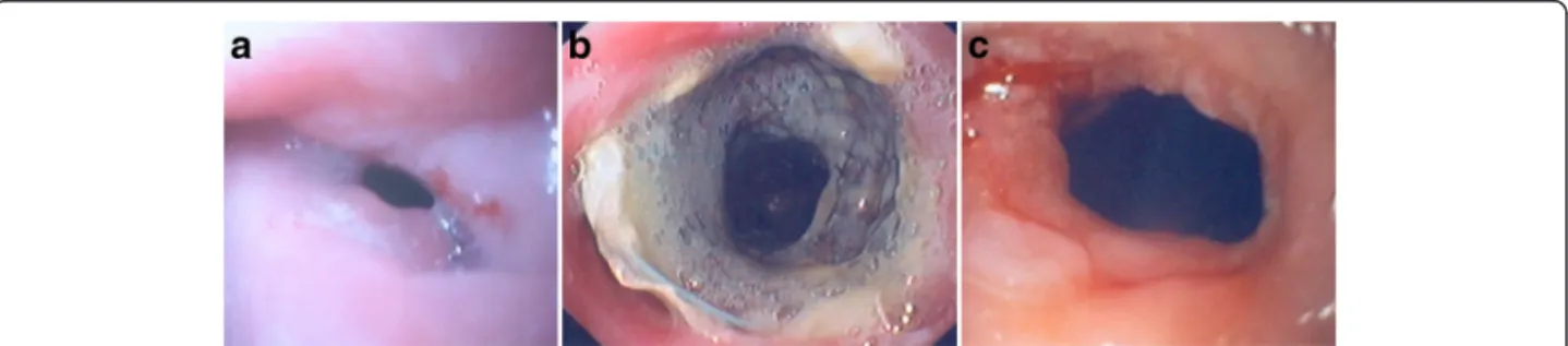 Figure 2 (a) Endoscopic view of an anastomotic stricture before stent placement. (b) Endoscopic view of a fully cover SEMS 3 months after stent deployment