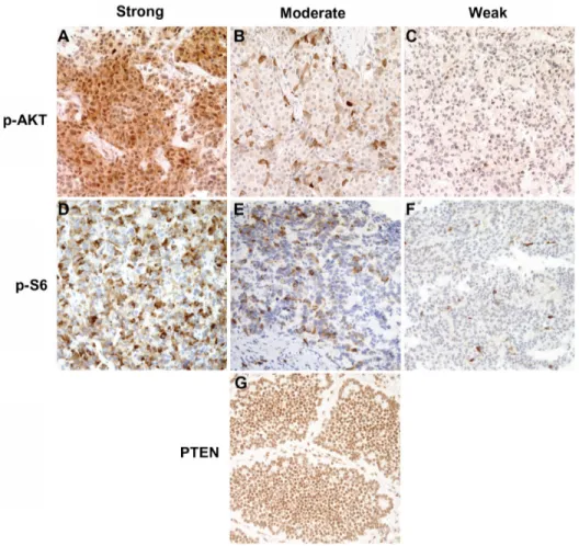 Figure 1  Immunohistochemical staining of phosphorylated AKT, p-AKT(ser473) phosphorylated s6, p-s6(ser240/244), and PTEN in neuroendocrine tumor samples using  epitope-specific antibodies