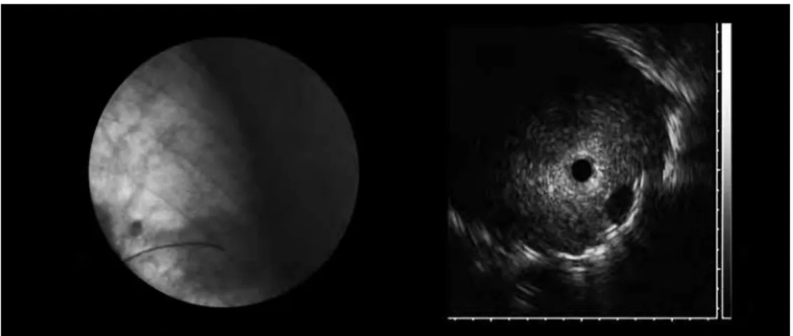 Fig. 6 – Fluoroscopia de lesão pulmonar periférica localizada por ecoendoscopia radial visualizando-se  formação hipoecogénica heterogénea com reforço hiperecogénico circundante 