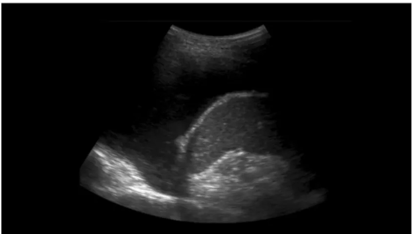 Fig. 7 – Padrão hipoecogénico heterogéneo, espessamento da pleura visceral e nodularidade da pleura  diafragmática em doente com derrame pleural maligno (adenocarcinoma do pulmão) 