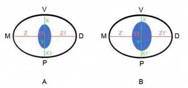 FIGURA 4- Esquema representativo da avaliação tomográfica em cada corte  antes (A) do preparo dos canais radiculares e depois do preparo (B)