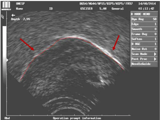Figura 1: O traçado em vermelho foi sobreposto a imagem ultrassonográfica da  superfície da língua