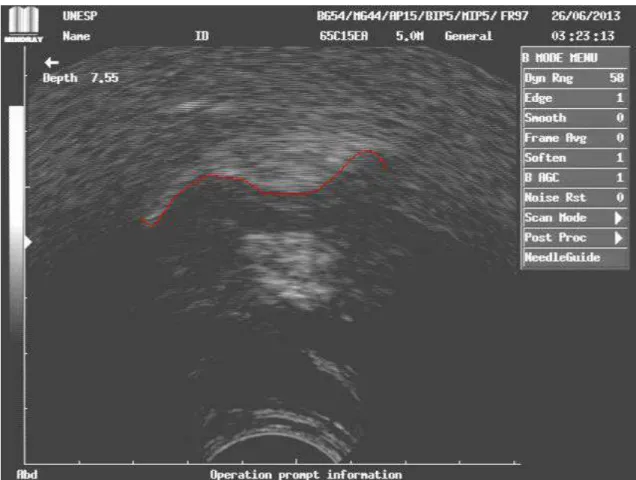 Figura 5: Imagem capturada de ultrassom corresponde à fase 3 da  visualização ultrassonográfica da deglutição orofaríngea em corte sagital