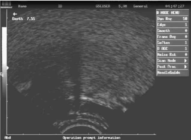 Figura 6: Imagem capturada de ultrassom corresponde à fase 4 da  visualização ultrassonográfica da deglutição orofaríngea em corte sagital
