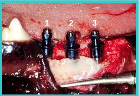 FIGURA 5 -  Implantes instalados com os montadores. Implante 1 – região  distal; Implante 2 – mediano e implante 3 – mesial