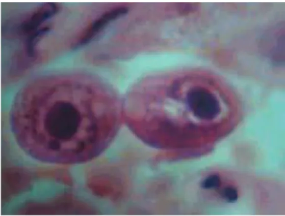Figura 1  –  Efeito Citopático do Vírus Citomegálico Humano (adaptado de  Griffiths, Paul D