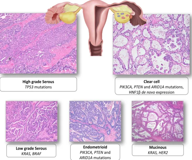 Figure  1.  1  -  Representative  examples  of  the  five  main  types  of  ovarian  carcinoma  stained  with hematoxylin and eosin (H&amp;E) 