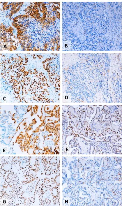 Figure 2. 3 - Representative examples of immunostaining for p16, p21, p53 and cyclin D1 in  different histological types of ovarian cancer 