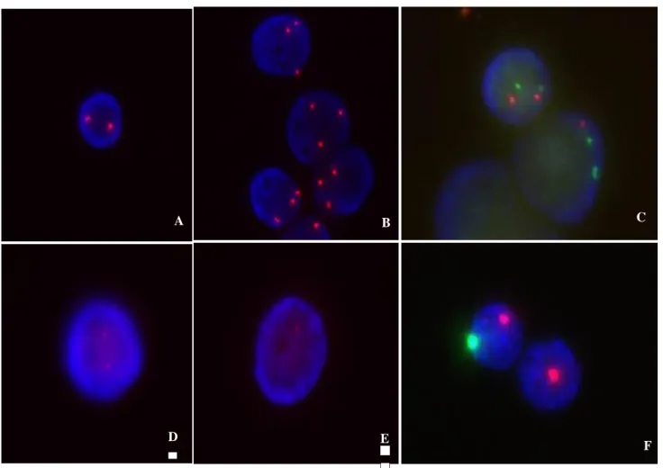 Figura  5:  Imagens  de  FISH  com  um  exemplo  da  normalidade  e  anormalidade  encontrada  (A-  FISH  em  células  de  interfase  normais  com  a  sonda  CEP  8  SpectrumOrange  DNA  Probe  Kit;  B-  FISH  em  células  de  interfase  com  alteração  ge