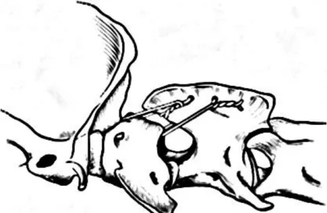 Figure 3 - Final arrangement of wires in Dorsal Wire Fixation (adapted from Sharp and Wheeler,  2005)