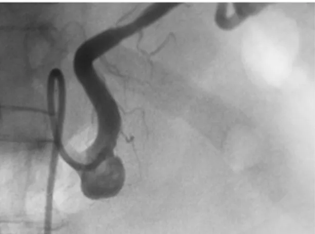 Figure 1. Selective angiograph of the splenic artery showing a  wide-necked saccular aneurysm of the proximal segment.