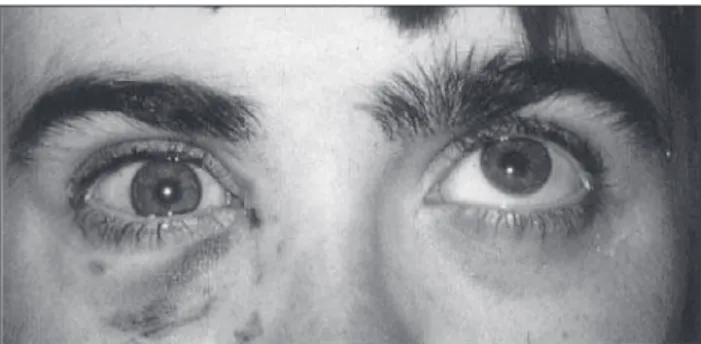 FIGURA 1: Paciente com fratura do assoalho orbitário, mostrando enoftalmo e hipotropia do olho direito