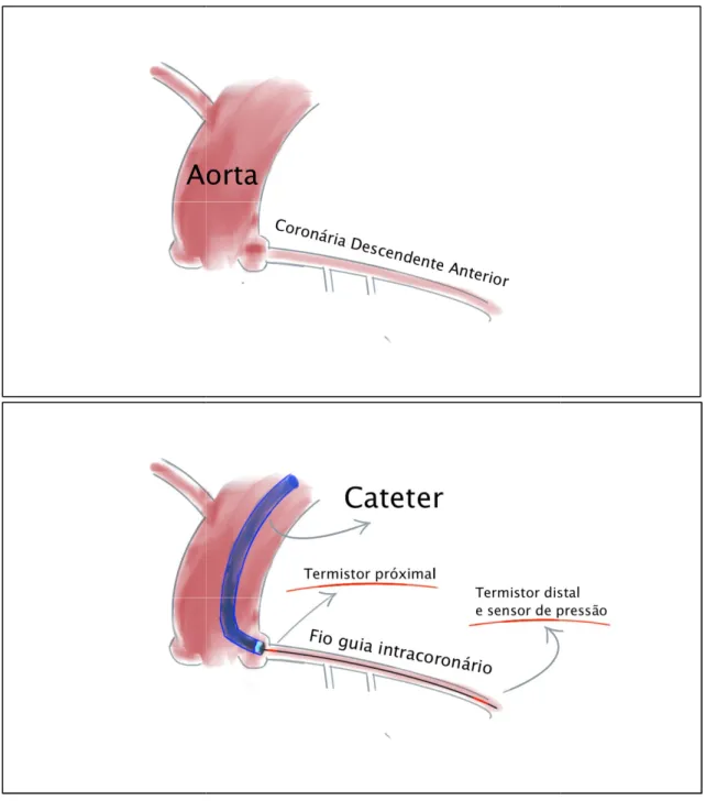 Figura 8 – Ilustração da ava A  –  Aorta  e  artéria  descend esquerda e fio guia no inter cateter  funciona  como  termís distal